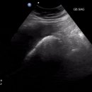 기종성 담낭염 Emphysematous Cholecystitis 이미지