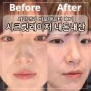 시크릿 | 시크릿레이저 쥬베룩 내돈내산 후기 비포애프터