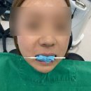 내이처럼치과병원 | [논현역치과] 무삭제 라미네이트 블랑쉬 내돈내산 솔직 후기