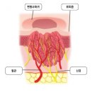 장승호 | 과천 편평사마귀 제거 후에도 재발한다는 후기? 이유는 이렇습니다