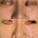 예솜의원 | 잠실새내피부과 리센츠피부과에서 mla레이저, 피코mla 모공 레이저 솔직 후기