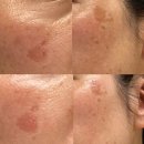 참자연약국 | 약국 기미크림 사용 잡티 제거 &amp; 예방 홈케어 후기