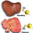간암 증상과 치료법에 대해 알아보면서 간암에 대한 두려움과 무서움을 이겨내도록 합시다. 이미지
