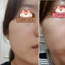 얼굴주름 팔자주름 리프팅 초음파 마사지기 웰로 리프텐으로 홈케어 시작한지 2주차