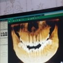 신동인치과의원 | 인천 계산동 신동인치과의원 사랑니 발치후 후기!