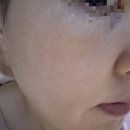 성남 오아로피부과/ 더마샤인 쥬베룩 프리미엄 물광주사 6cc (3회차/5회)/ 내돈내산