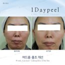 [원데이필 임상결과 - 에스지코스] 안전한 약초 필링 추천