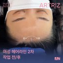 김포두피문신 | 얇은 피부타입 여성 헤어라인 교정 2차 작업 후기