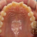 나비치과의원 | 나비 앞니 부분교정, 설측교정으로 4개월에 개선된 후기 사례