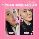 기대플러스병원 | 칙칙한 피부톤 개선, 송도 피부과 피코플러스토닝 7일 후기