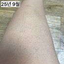 삼성제일의원 | 여자종아리제모 후기 삼성역제모 실킨제모 7회차 효과