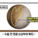 [대찬병원] 임석민 원장님이 알려주는 카티스템｜무릎 줄기세포 치료에 관한 모든 것! 이미지