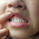 기성팜 코리아 | 유아 부정교합 교정치료 2달 후기( 비용 / 효과 / 반대로 물리는 치아 / 소아 1차교정상담)