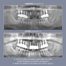 안정T치과의원 | 앞니 임플란트 후기? 흔들리는 앞니, 이렇게 해결했습니다