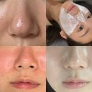 부산 엑소좀보다 좋았던 모공관리 리뉴테라피 스킨부스터 솔직후기