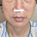 김제장문외과의원 | 안면거상 수술 후기: 일주일