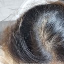 부산맥스웰피부과의원 | 탈모 치료 받은 후기 (맥스웰피부과의원, 내돈내산)