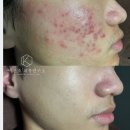 인천 화농성 여드름 붉은 흉터 자국 피부관리 후기 케이속건조피부연구소