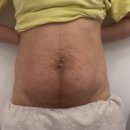 (주)보람전자 | [공지] 대구 수성구 복부 비만(출산후 온다리팅 바디후기)