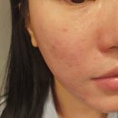 부천여드름관리 쏘울터치 방문후기 내 본연 피부의 문제를 해결(내돈내산)