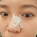 신사한의원 | 강남 신사역 피부과 한의원에서 패인흉터 새살침 치료로 제거하기 1탄!