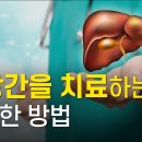 지방간 치료 가능합니다. 치료 해야만 합니다 이미지