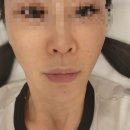 봉봉성형외과 | 강남역 성형외과 튠페이스+얼굴지방분해주사 통증 효과 후기,