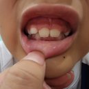 민치과 앞 | 압구정민치과 어린이부정교합 아이 둘 프랑켈교정 1년차 2년차 내돈내산 기록 1탄