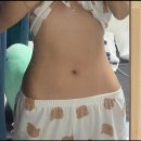 [바디업의원] 19년 통통이 인생의 종지부 일기_상체 지방흡입 후기