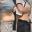 하루에 멍 | [공지] 복부지방흡입 내돈내산 후기 2개월차 멍, 붓기, 흉터관리 방법