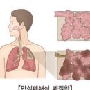 만성 폐쇄성 폐 및 (COPD, 숨이 차는 ) 이미지