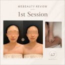 예쁜얼굴 | 위뷰티 승모근관리전후 예쁜얼굴 피부관리 1회차 후기