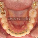 이다듬치과의원 | 앞니 부분교정 하다가 결국 전체교정으로...돌출입 해소 효과의 차이점과 치간삭제 양, 한계