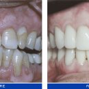 [라미네이트/치아성형] 치아성형과 병행할 수 있는 치료 이미지
