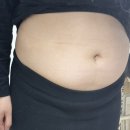 어서멍 | 수원 복부무한람스 당일~1주일 후기 + 통증, 멍, 붓기