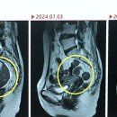 자궁경부암 3기/ 림프전이 환자의 드라마틱한 케이스 이미지