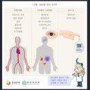 제2형 당뇨병[인슐린의 기능이 저하된 인슐린 저항성을 보이는 질환] 이미지