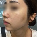 분당 미금피부관리 &lt;올가드림뷰티 미금점&gt; 모공디톡스+데콜테 후기, 재방문 의사 有