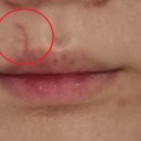 청담필즈성형외과의원 | 열상으로 인한 얼굴 봉합 수술 그리고 현재 4편 [청담지움 성형외과 2]