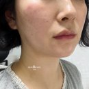 압구정동 | 압구정동피부과, 쿨소닉 리프팅 10000샷 솔직후기(가격, 효과, 전후비교)