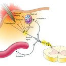 섬유근통증후군 이미지