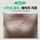 진성레이져 | [청담 피부과 전문의] 구진성 흉터 레이저 치료 방법, 치료 후기에 대한 생각