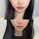 제가한의원 | [강남역 한의원] 강남 리프팅 전문 한의원 V라인 얼굴 실리프팅 후기