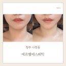 제5회 청주연묵회전 | 청주 사천동 피부&amp;윤곽관리 효과? 직접 받아본 에르벨에스테틱 후기