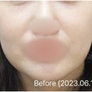 맑고고운의원 수원점 | 수원 실리프팅, 사각턱과 같았던 환자 후기