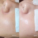 동탄순환대로14길 | 동탄 피부관리 후기 드로에스테틱 여드름 압출 케어