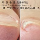 강자안손톱 이미지