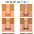 커스텀 3D 콧대성형 100만원 왕대박 이벤트(2011.11.29~12.20) 이미지