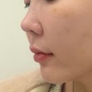 덜아픈세상레이저의료기 | 한남동피부과 셀르디엠리투오 스킨부스터 효과 내돈내산 후기