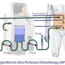 복막 전이 환자의 온열 복강내 화학요법 이미지